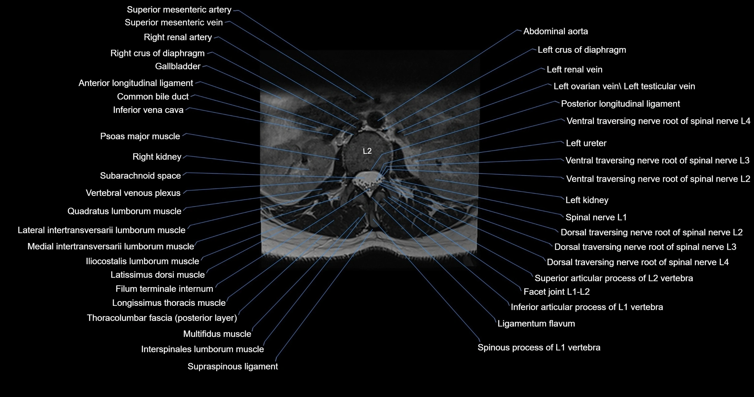 MRI lumbar spine axial cross sectional anatomy 3T radiology  image-img-00001-00013.webp